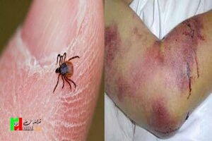 پیشگیری از تب کریمه کنگو